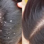 DIY Natural Dandruff Treatments