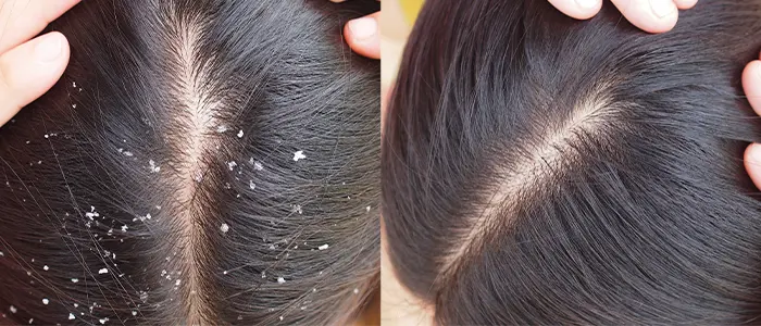 DIY Natural Dandruff Treatments