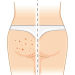 Home Remedies To Get Rid Of Butt Acne And Prevention Tips