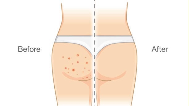 Home Remedies To Get Rid Of Butt Acne And Prevention Tips