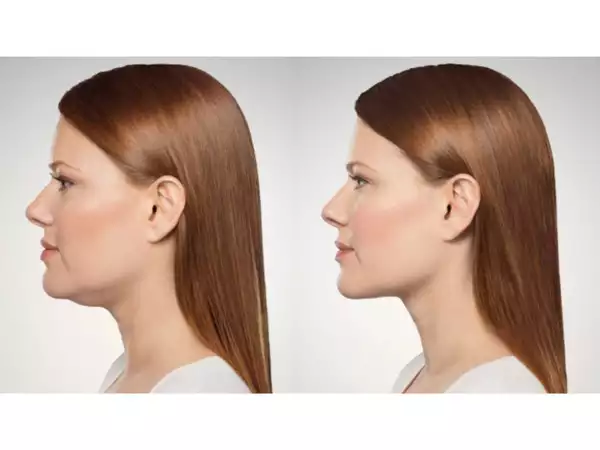 How to get rid of double chin using Gua Sha