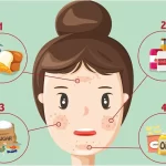 Acne Diet I followed