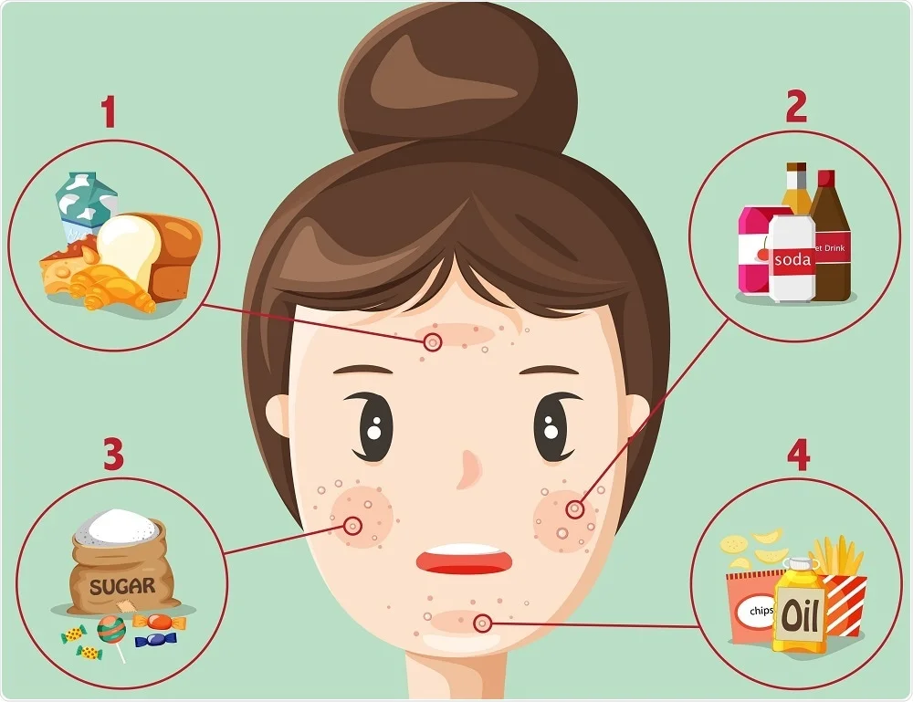 Acne Diet I followed