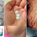 How To Get Rid Of Stretch Marks Very Fast By Using Aspirin!