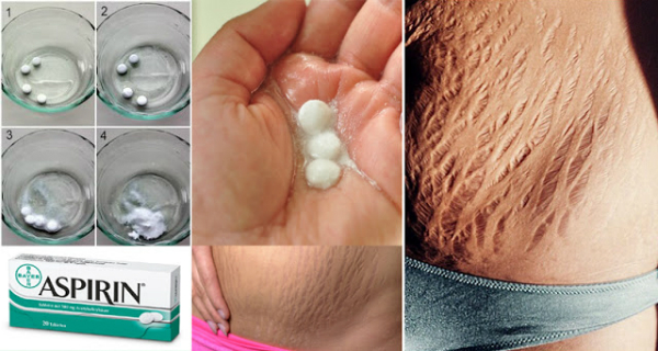 How To Get Rid Of Stretch Marks Very Fast By Using Aspirin!