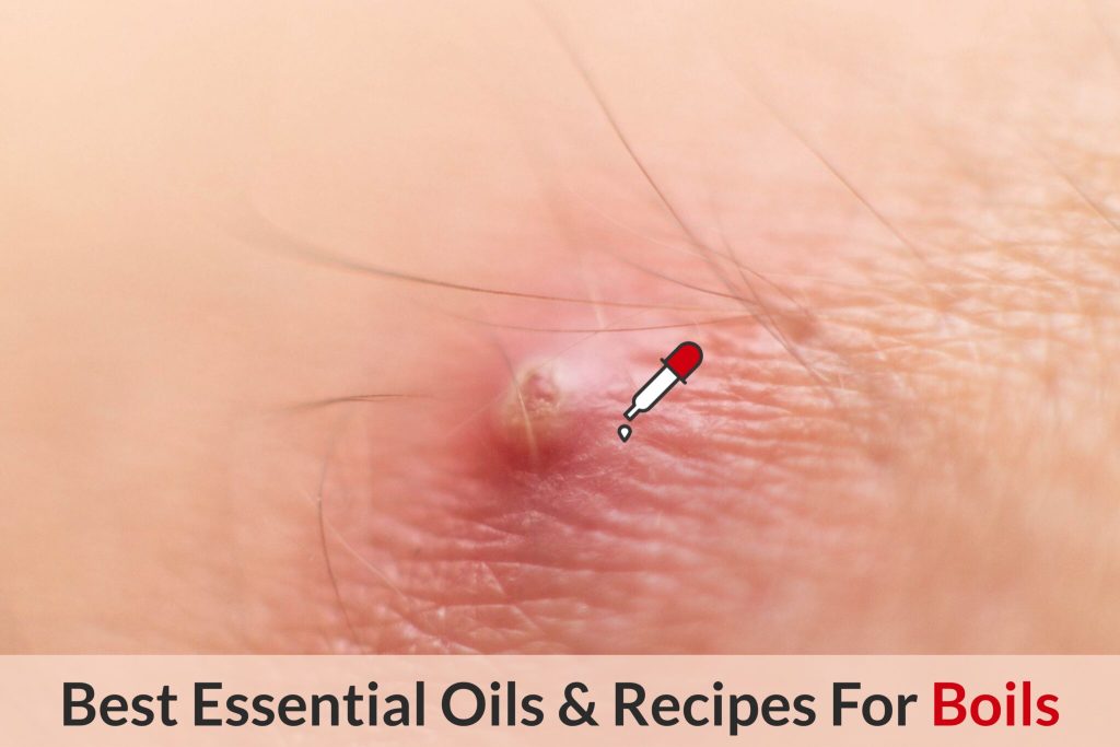 Top 5 Essential Oils for Boils