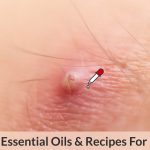 Top 5 Essential Oils for Boils