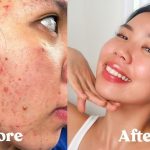 How I Got Rid of My Acne