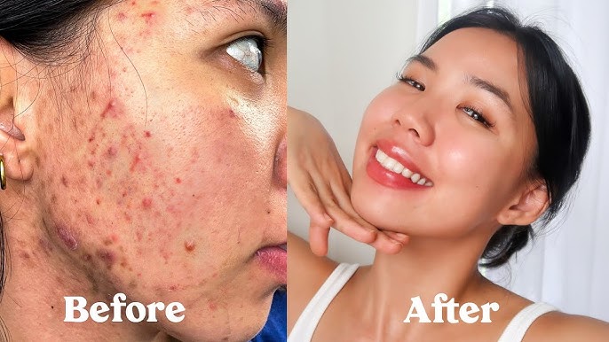 How I Got Rid of My Acne