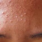 How To Get Rid Of Forehead Acne – 9 Home Remedies To Try