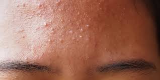 How To Get Rid Of Forehead Acne – 9 Home Remedies To Try