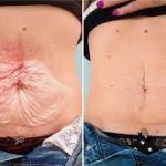 How to tighten flabby skin after weight loss