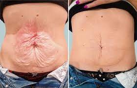 How to tighten flabby skin after weight loss