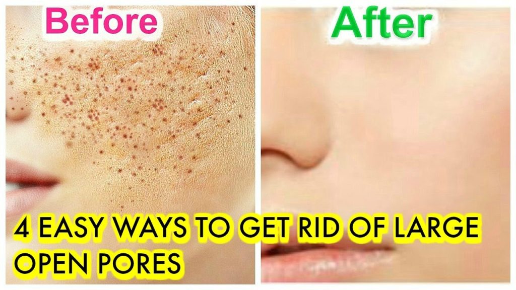 Minimize Pores Naturally: At-Home Remedies And Prevention Tips