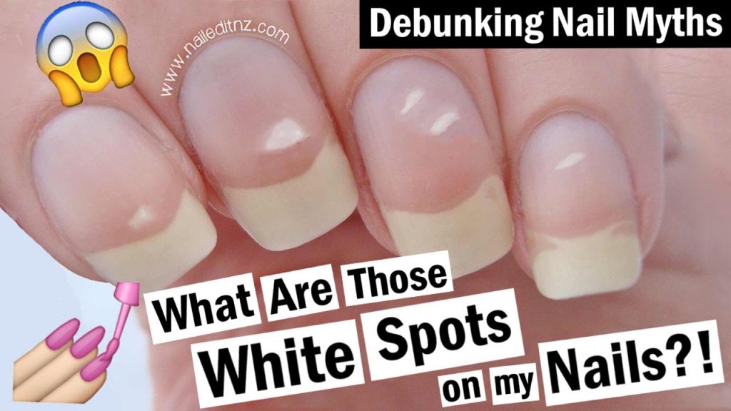 What Are White Spots On Nails And How To Get Rid Of Them?