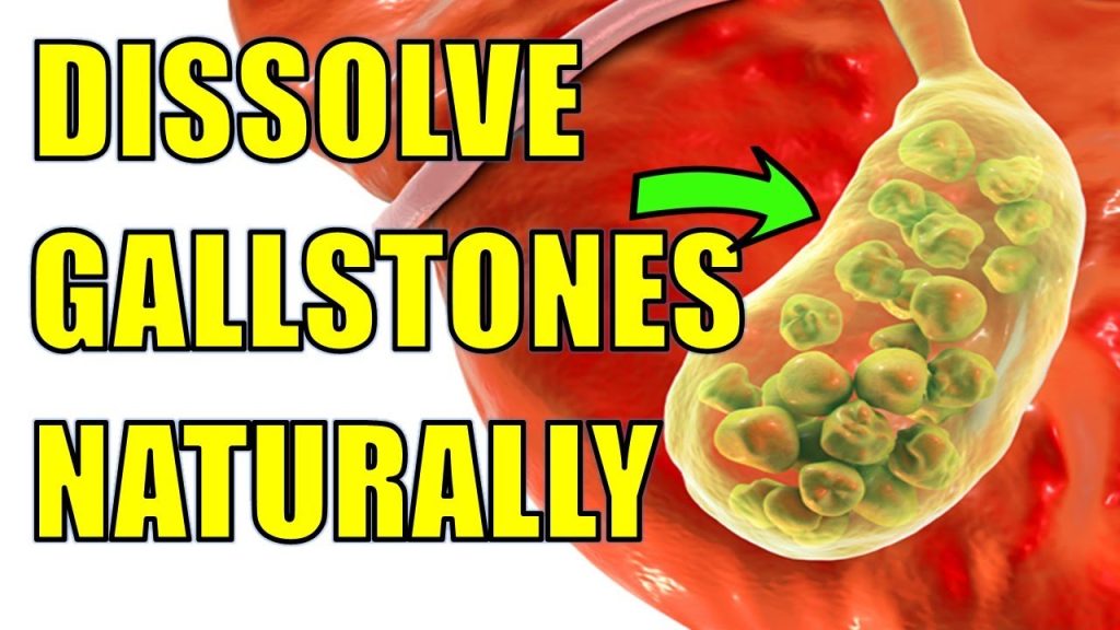 How to Get Rid of Gallstones Naturally