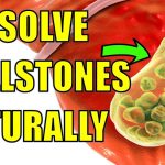 How to Get Rid of Gallstones Naturally