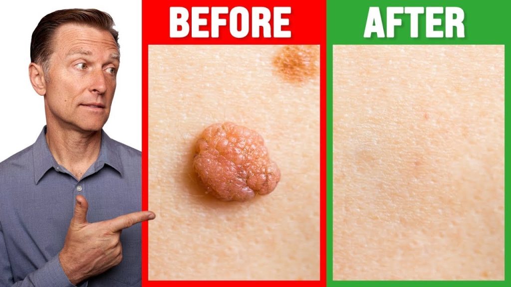 Skin Tag: Natural DIY Methods oFuremoving Mole, Wart and Skin Tag