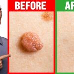 Skin Tag: Natural DIY Methods oFuremoving Mole, Wart and Skin Tag