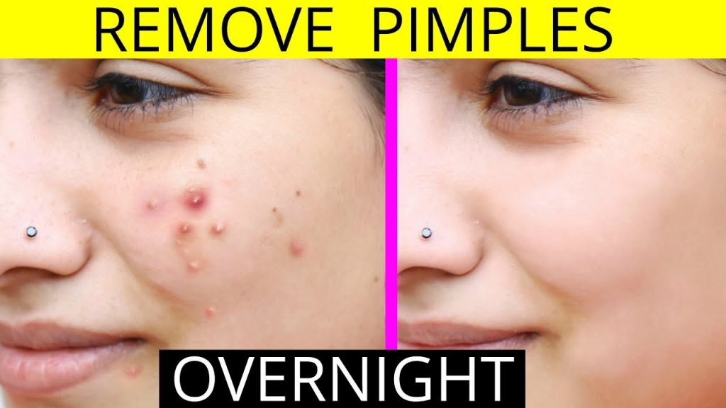 How to get rid of pimples