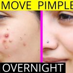 How to get rid of pimples