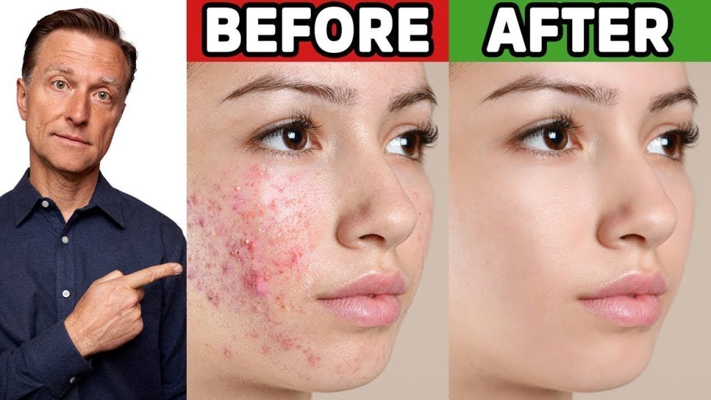 How to get clear skin fast!