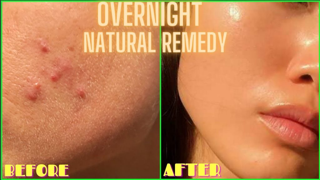 DIY ACNE TREATMENT: HOW TO GET RID OF PIMPLES OVERNIGHT | YOURGIRLKNOWS