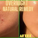 DIY ACNE TREATMENT: HOW TO GET RID OF PIMPLES OVERNIGHT | YOURGIRLKNOWS