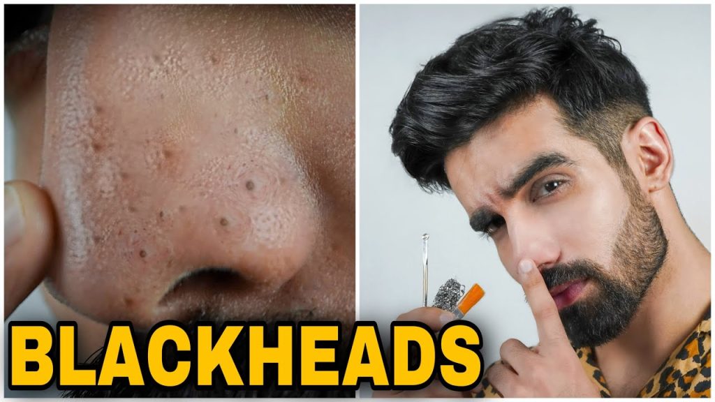 How to Get Rid of Blackheads: 12 Blackheads Removal Home Remedies That Work Like Magic