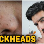 How to Get Rid of Blackheads: 12 Blackheads Removal Home Remedies That Work Like Magic