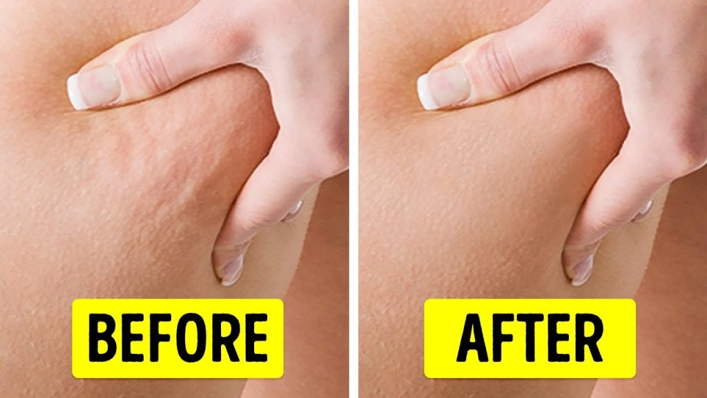 In Just 2 Weeks Get Rid Of Cellulite Fast Naturally