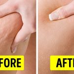 In Just 2 Weeks Get Rid Of Cellulite Fast Naturally