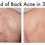 How To Get Rid Of Back Acne Using Home Remedies