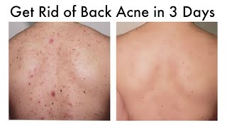 How To Get Rid Of Back Acne Using Home Remedies