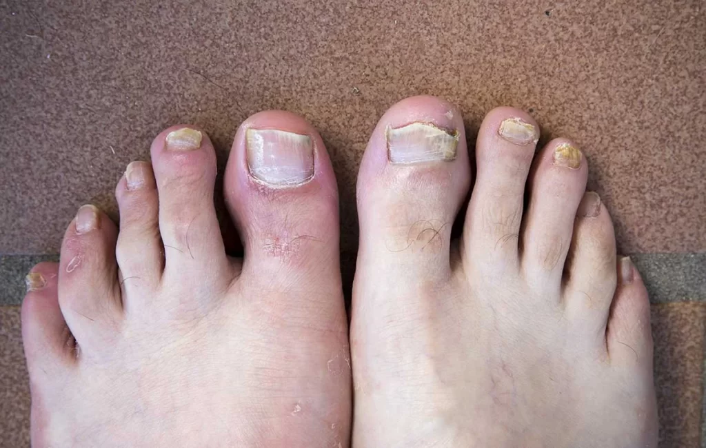 How To Use Hydrogen Peroxide For Toenail Fungus?