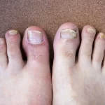 How To Use Hydrogen Peroxide For Toenail Fungus?