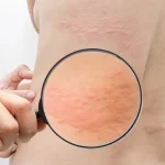 How to Get Rid of Hives: 6 Natural Remedies that Help