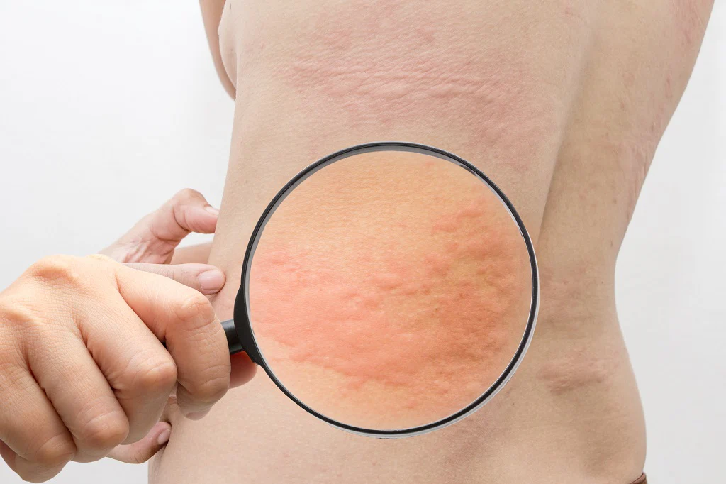 How to Get Rid of Hives: 6 Natural Remedies that Help