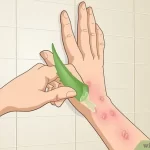 How To Get Rid Of A Poison Ivy Rash Overnight