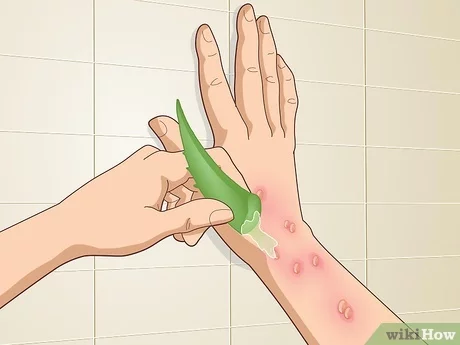 How To Get Rid Of A Poison Ivy Rash Overnight