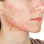 How To Get Rid of Hormonal Acne Naturally & Reliably: A 7-Step Plan For Skin