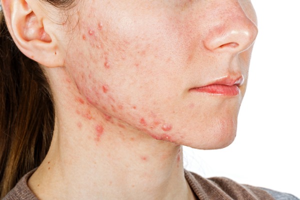 How To Get Rid of Hormonal Acne Naturally & Reliably: A 7-Step Plan For Skin