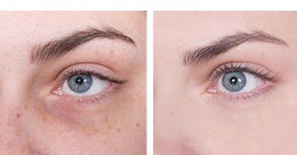 How To Use Baking Soda Reduce Dark Circles And Bags Under The Eyes 👍👍👍👁👁