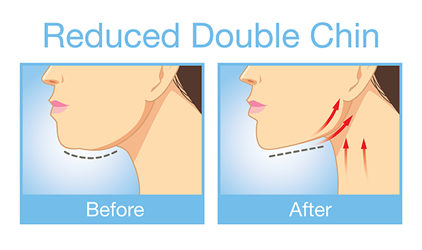 Remove double chin exercises | Remove double chin fast | how to get rid of double chin