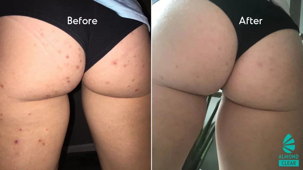 How To Get Rid Of Butt Acne Fast