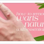 How to Remove Moles and Warts with Essential Oils