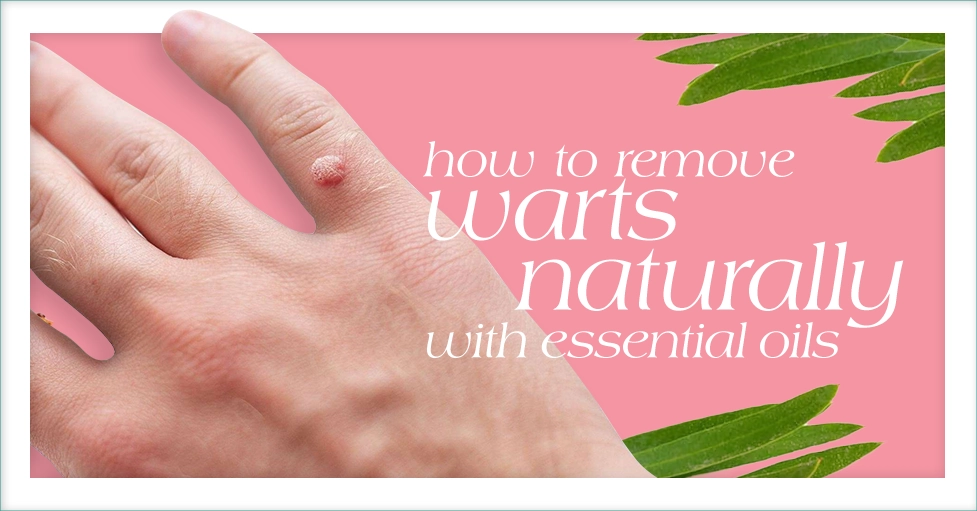 How to Remove Moles and Warts with Essential Oils