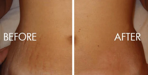 Fade Stretch Marks! | Ingredients That WORK And The Science To Back It Up