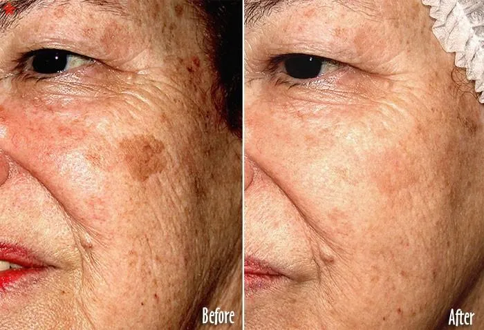 SIMPLE TRICK TO REMOVE BROWN SPOTS FROM YOUR SKIN