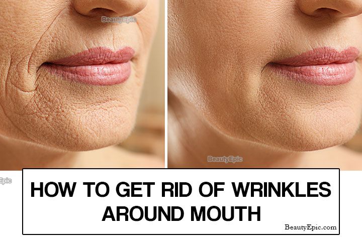 How to Get Rid of Wrinkles Around Mouth?